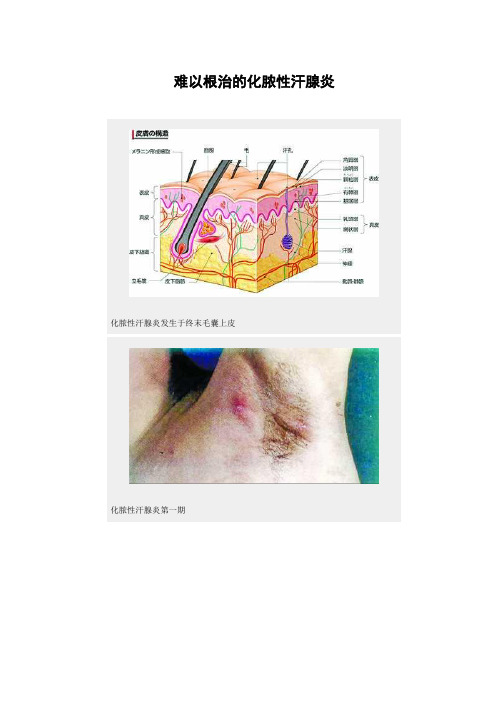 难以根治的化脓性汗腺炎