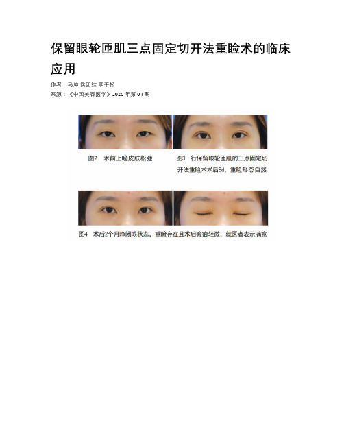 保留眼轮匝肌三点固定切开法重睑术的临床应用