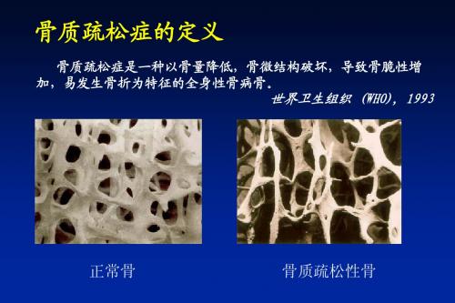 骨质疏松的若干临床问题
