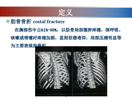 肋骨骨折PPT课件