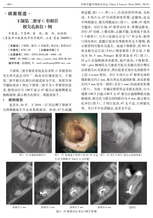 下颌第二磨牙C形根管根尖孔移位1例
