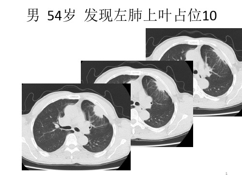 病例随访肺部占位课件