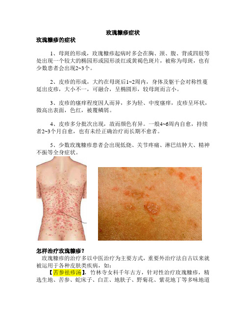 玫瑰糠疹症状