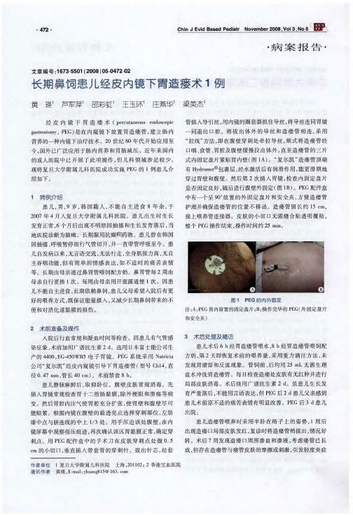 长期鼻饲患儿经皮内镜下胃造瘘术1例