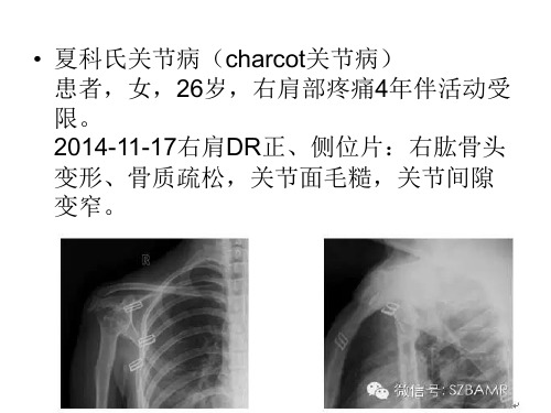 夏科氏关节病