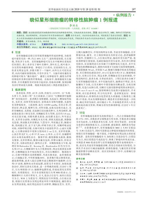 貌似星形细胞瘤的转移性脑肿瘤1例报道