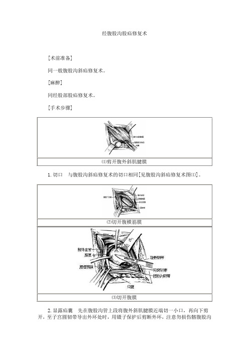 经腹股沟股疝修复术
