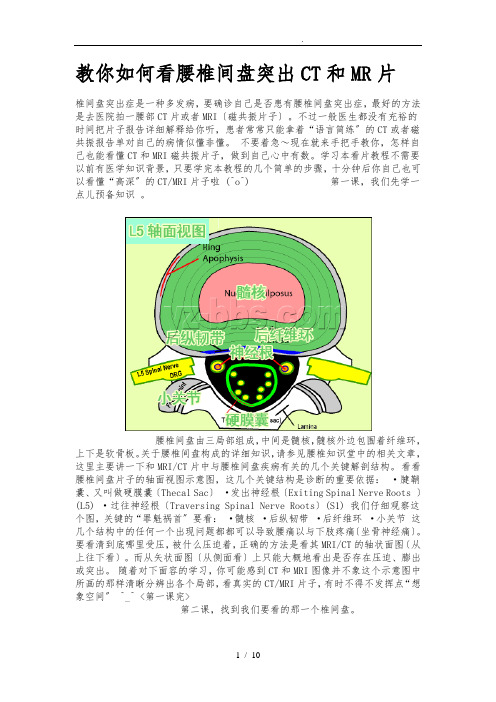 教你如何看腰椎间盘突出CT和MR片