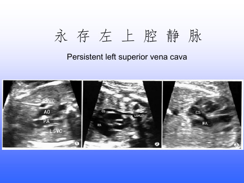 永存左上腔静脉ppt课件