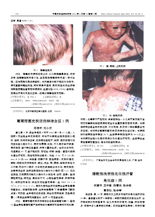 梅毒性脱发