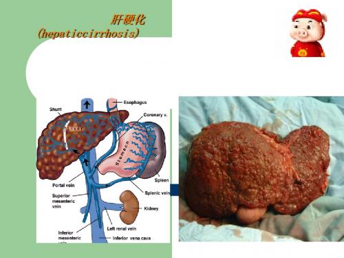 肝硬化完整PPT课件
