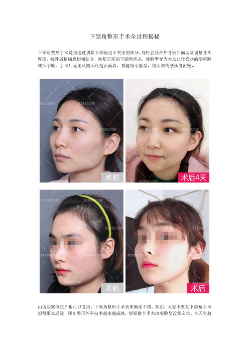 下颌角整形手术全过程揭秘