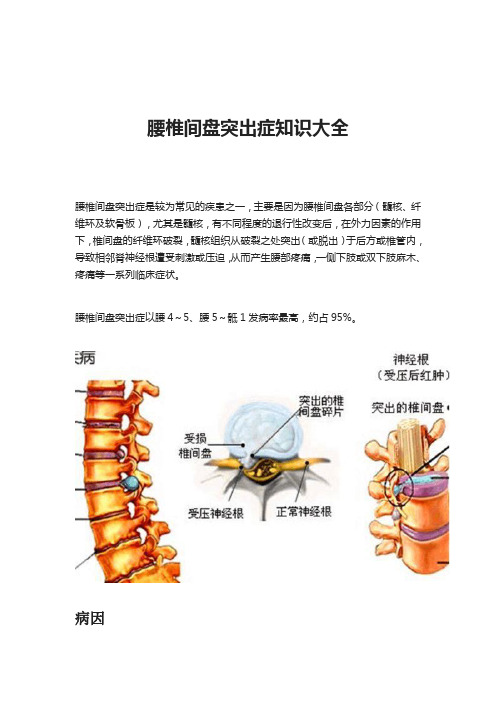 腰椎间盘突出症知识大全