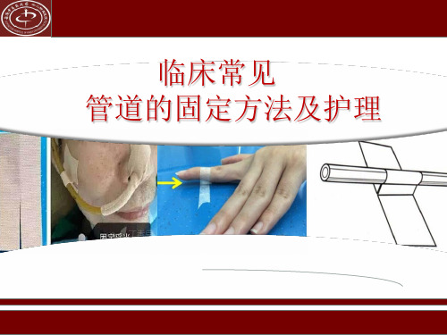 临床常见管道的固定方法及标识