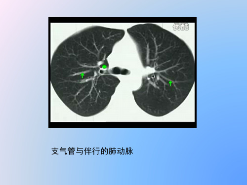胸部CT入门胸部解剖结构及常见病理征