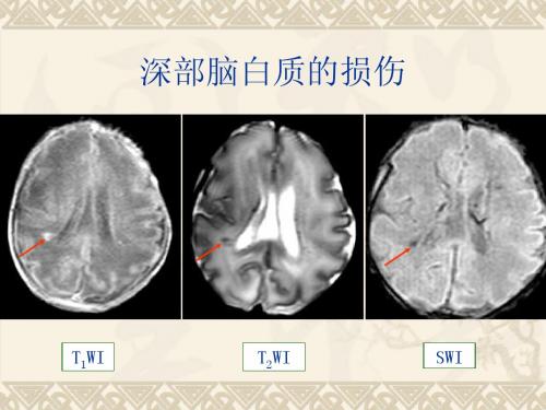 新生儿缺氧缺血或窒息所致脑损伤的影像学诊断