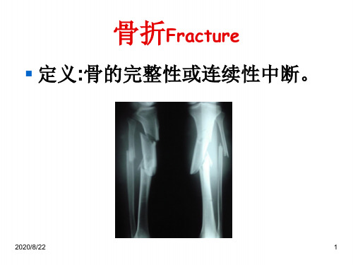 人卫第九版骨科课件 骨折概论