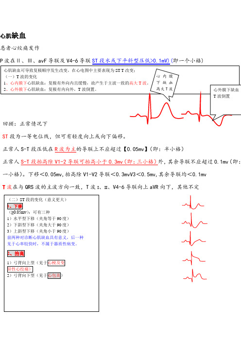 心肌缺血与梗死 心电图分析