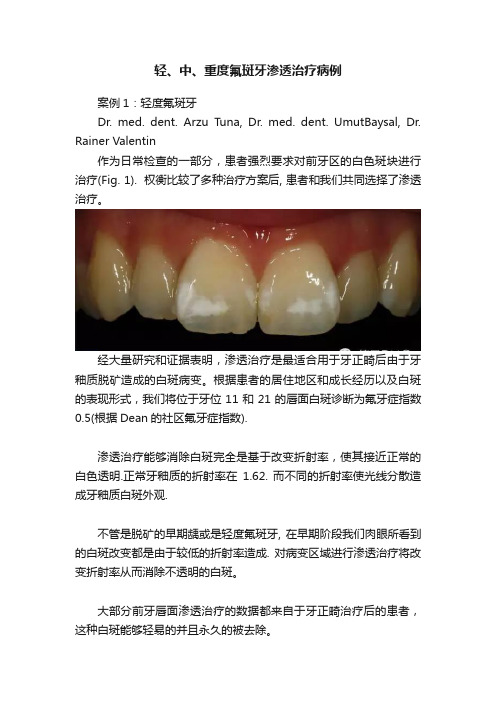 轻、中、重度氟斑牙渗透治疗病例