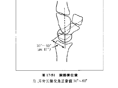 经舟骨骨折月骨周围背侧脱位