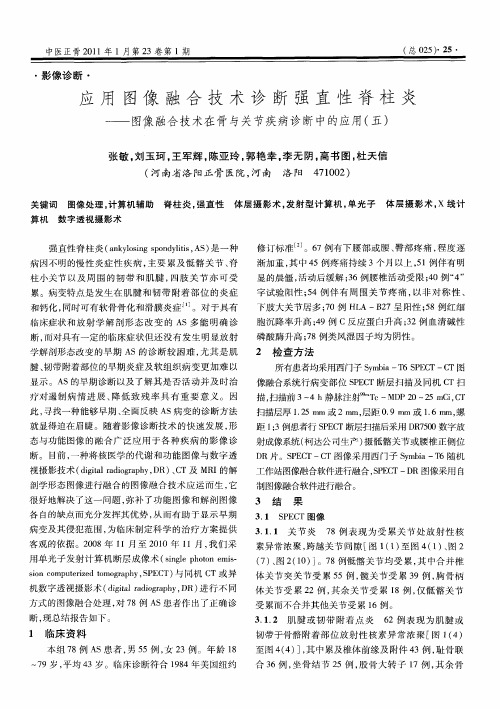 应用图像融合技术诊断强直性脊柱炎——图像融合技术在骨与关节疾病诊断中的应用(五)