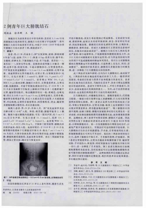 2例青年巨大膀胱结石