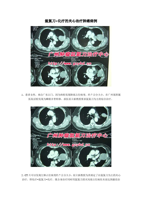 氩氦刀结合化疗夹心治疗肺癌