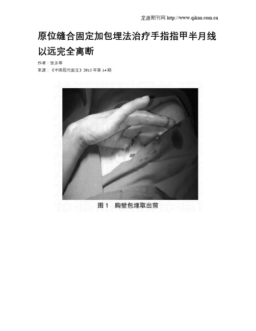 原位缝合固定加包埋法治疗手指指甲半月线以远完全离断