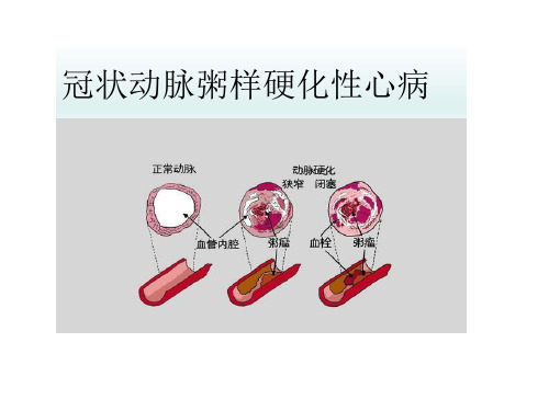 冠状动脉粥样硬化性心病