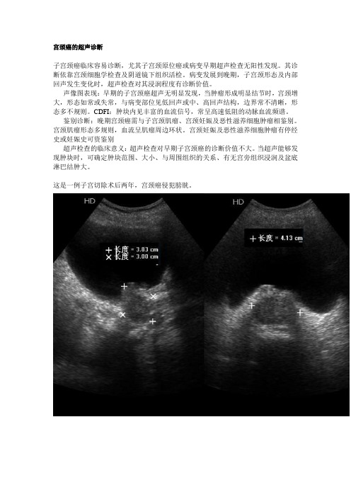 宫颈癌的超声诊断