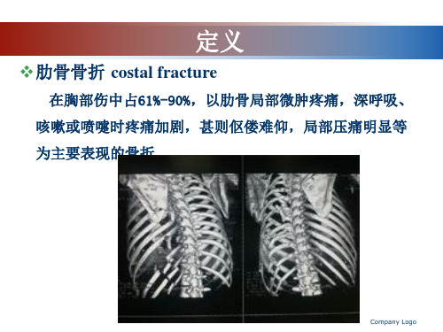 肋骨骨折影像学表现