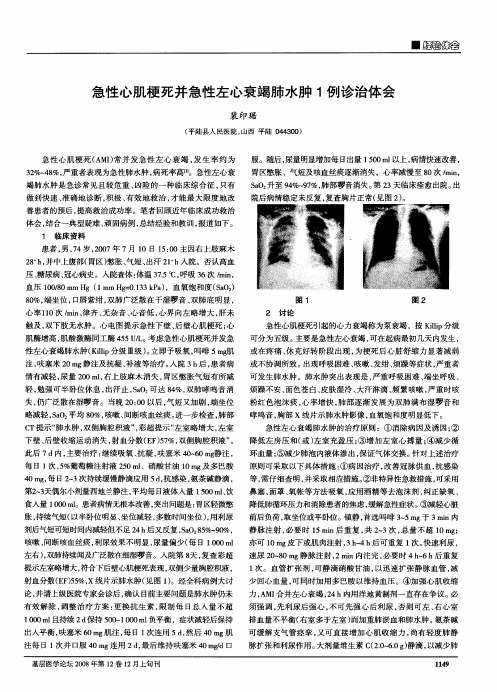 急性心肌梗死并急性左心衰竭肺水肿1例诊治体会
