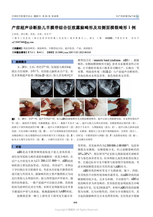 产前超声诊断胎儿羊膜带综合征致露脑畸形及双侧面横裂畸形1例