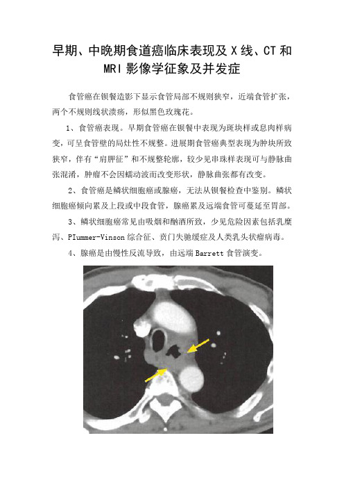 早期、中晚期食道癌临床表现及X线、CT和MRI影像学征象及并发症