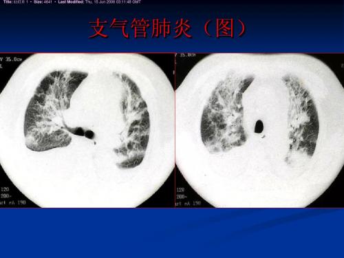 医学影像诊断学-呼吸系统4