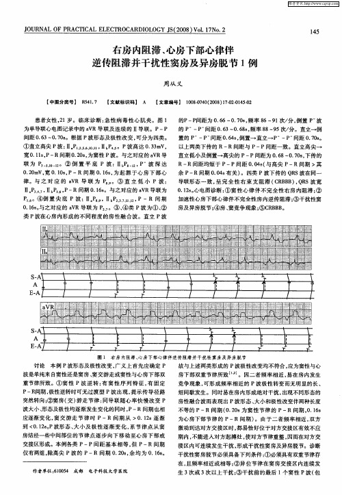 右房内阻滞、心房下部心律伴逆传阻滞并干扰性窦房及异房脱节1例