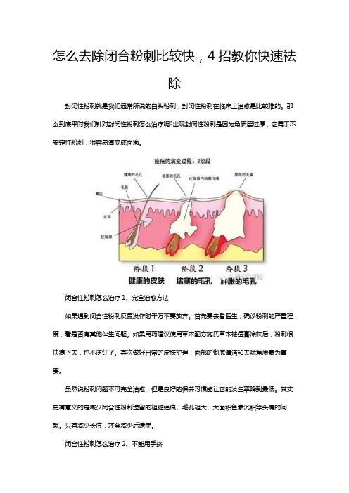 怎么去除闭合粉刺比较快,4招教你快速祛除