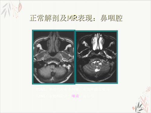 鼻咽癌MR诊断课件PPT