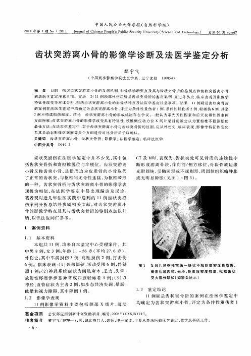 齿状突游离小骨的影像学诊断及法医学鉴定分析