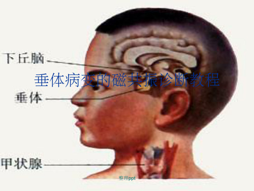 垂体病变的磁共振诊断教程