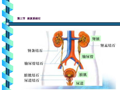 泌尿系结石 (2)ppt课件