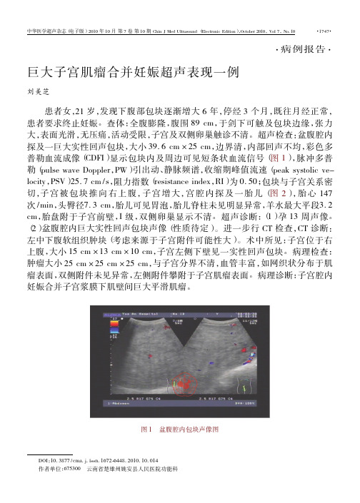 巨大子宫肌瘤合并妊娠超声表现一例