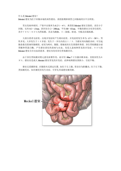 什么是Meckel憩室