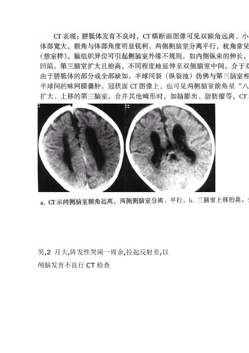 畸形：胼胝体发育不良