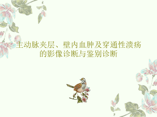 主动脉夹层、壁内血肿及穿通性溃疡的影像诊断与鉴别诊断71页PPT