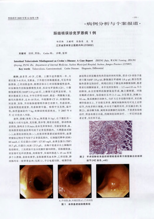 肠结核误诊克罗恩病1例