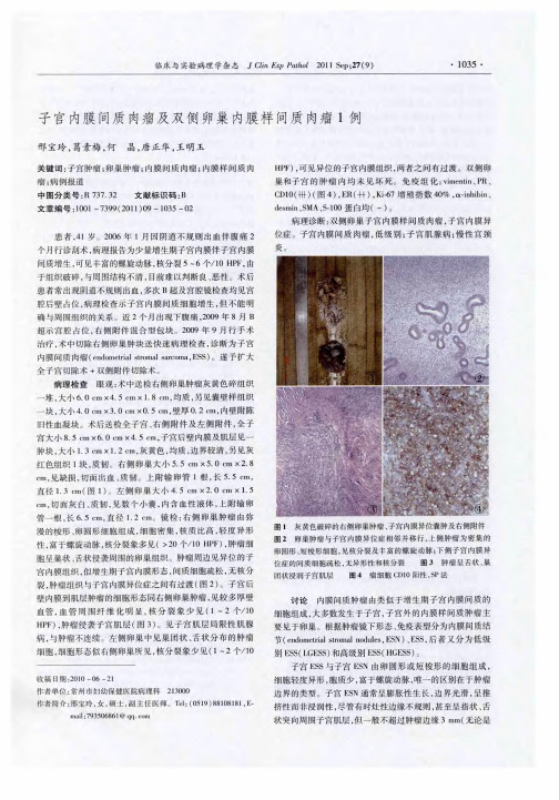 子宫内膜间质肉瘤及双侧卵巢内膜样间质肉瘤1例