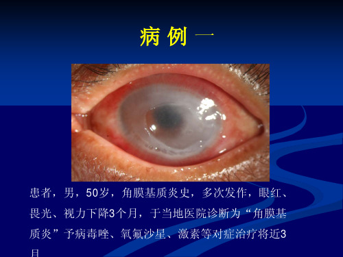药物毒性角膜炎