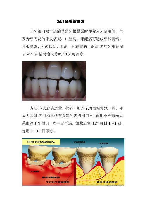 治牙龈萎缩偏方【范本模板】