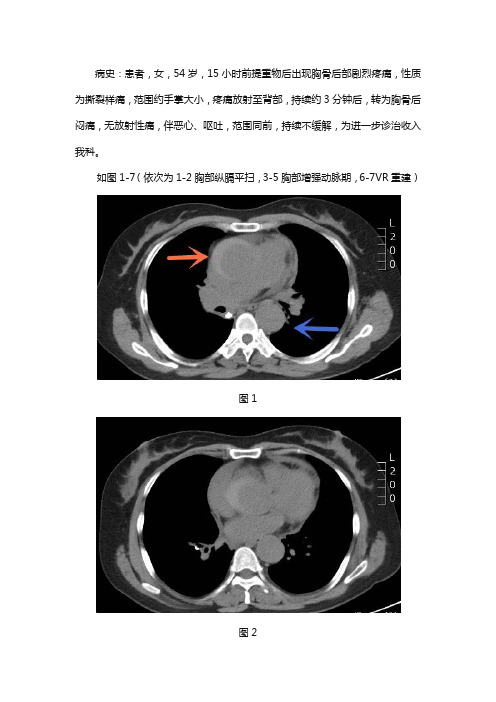 老年女性升主动脉旁半月形高密度影--主动脉壁内血肿